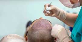 Affordable Hair Transplantation Cost in Jaipur, Jaipur