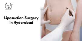Liposuction surgery in Hyderabad, Hyderabad