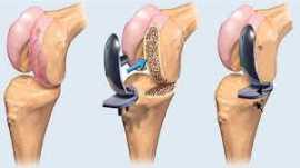 Dr. Amit Agarwal I Best Knee Replacement Surgeon , New Delhi
