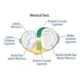 Fix Your Knee with Expert Meniscus Tear Surgery, Melbourne