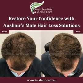 Restore Your Confidence with Aushair's Male Hair, Melbourne