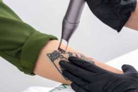 Revamp Your Look with Laser Tattoo Removal, Delhi