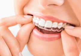The Complete Guide to Invisalign Dental Treatment , Hayward