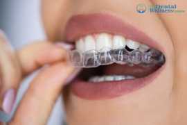 Transform Your Smile with Customized Invisible , Ahmedabad