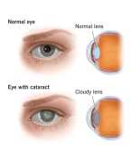 Clear Vision Ahead: All About Cataract Surgery, St Kilda