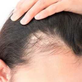 Best Women's Hair Fall Treatment Perth, Subiaco