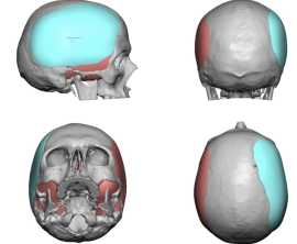 Skull Reshaping Surgery in San Francisco, CA, San Francisco