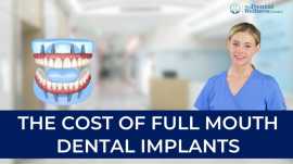 Discover the Benefits of Dental Implants at Dental, Ahmedabad