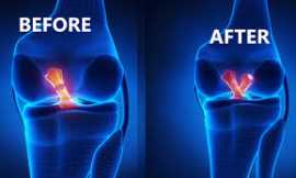 A Complete Guide to Effective ACL Ligament Surgery, Jaipur