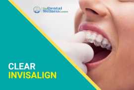 Transform Your Smile with Invisalign at The Dental, Ahmedabad