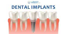 Dr. Vishal Patel - Expert Dental Implants in Ahmed, Ahmedabad