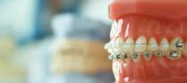 clear braces for teeth | Amini Ortho, San Antonio