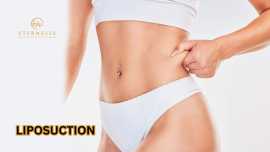 Liposuction In Hyderabad | Eternelle Aesthetics, Hyderabad