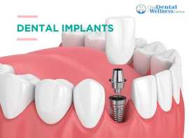 Restore Your Smile: Premier Dental Implants , Ahmedabad