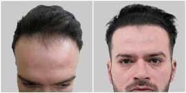 Trusted Clinic for Hair Transplant in Gurgaon, Gurgaon