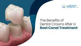 Comprehensive Root Canal Therapy at Our Dental Wel, Ahmedabad