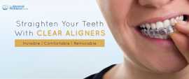 Clear Aligners at best price in Ahmedabad |Dental , Ahmedabad