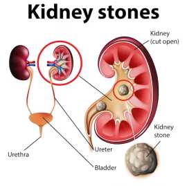 Effective Kidney Stone surgery in Delhi is Conduct, Delhi
