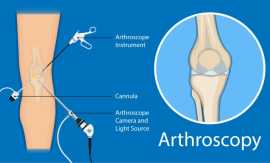 What You Need to Know About Arthroscopy Surgery in, Jaipur