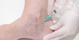 Sclerotherapy Treatment | Advanced Medical Group, Union City