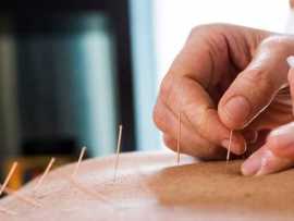 Acupuncture Treatment Toronto: Natural Healing Hub, Toronto