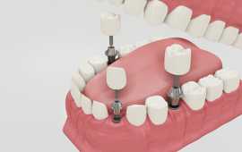 Dr. Manish Shah dental Implants in Ahmadabad , Ahmedabad