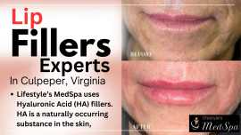 Lip Filler Experts in Culpeper at LSA, Culpeper