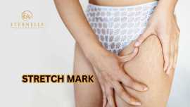 Stretch Mark Removal Treatment In Hyderabad - Eter, Hyderabad