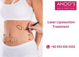 Advanced Laser Liposuction for fat removal|ANOOS, Hyderabad