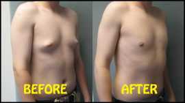 Gynecomastia surgery cost in Lahore, Lahore