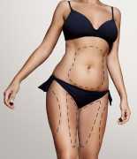 Liposuction Cost in Lahore, Lahore