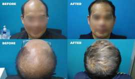 Amazing Results of Hair Regrowth Treatment AU, Subiaco