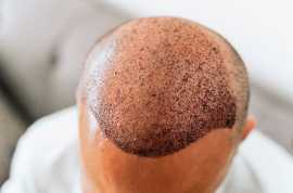 Get Confidence with FUE Hair Transplant Surgery, Richmond